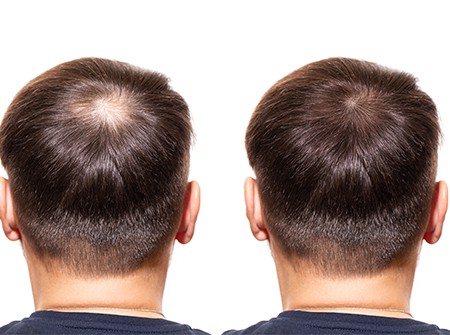 What Causes Hair Loss? | Elite Healthcare .